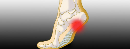 laser treatment for plantar fasciitis