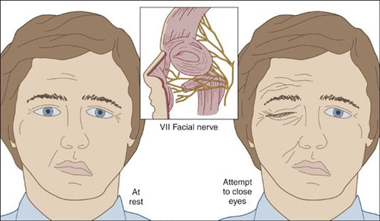 Laser therapy for Bell’s Palsy