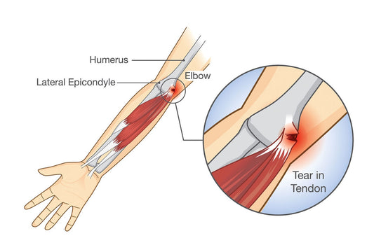 Laser Therapy for Tennis Elbow