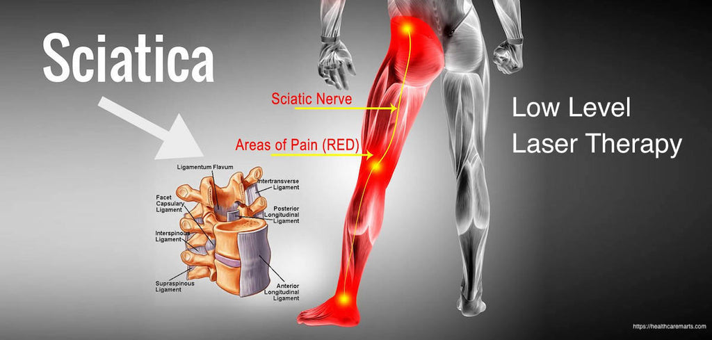 The Best Way to Treat Sciatica - Low Level Laser