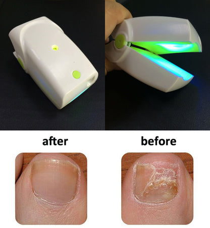 nail fungus laser treatment before and after